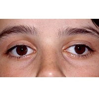 GÖZ NEZLESİ SALGININA DİKKAT!