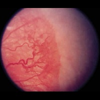 GÖZ NEZLESİ SALGININA DİKKAT!