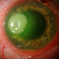 GÖZ NEZLESİ SALGININA DİKKAT!