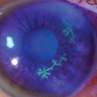 GÖZ NEZLESİ SALGININA DİKKAT!