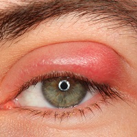 GÖZ NEZLESİ SALGININA DİKKAT!