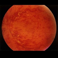 GÖZ NEZLESİ SALGININA DİKKAT!