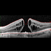 GÖZ NEZLESİ SALGININA DİKKAT!