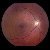 GÖZ NEZLESİ SALGININA DİKKAT!