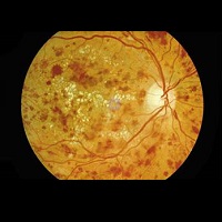 GÖZ NEZLESİ SALGININA DİKKAT!